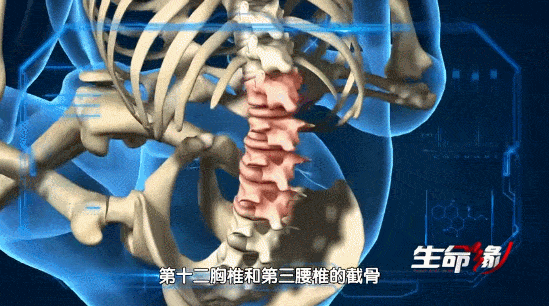 骨头被打入22根钢钉，身体被“敲断”4次：弯了28年后的中国男子，终于变直了！（组图） - 38