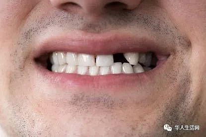 注意！最新发现：牙齿出现这些问题，很有可能是你感染了新冠病毒（组图） - 2