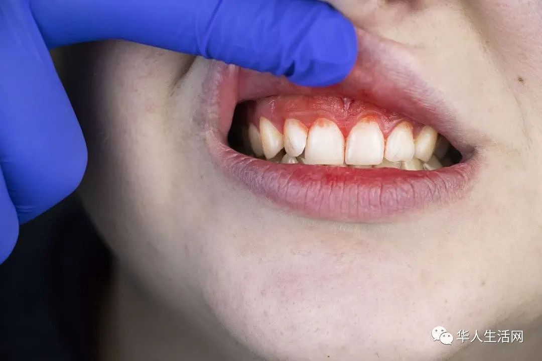 注意！最新发现：牙齿出现这些问题，很有可能是你感染了新冠病毒（组图） - 4
