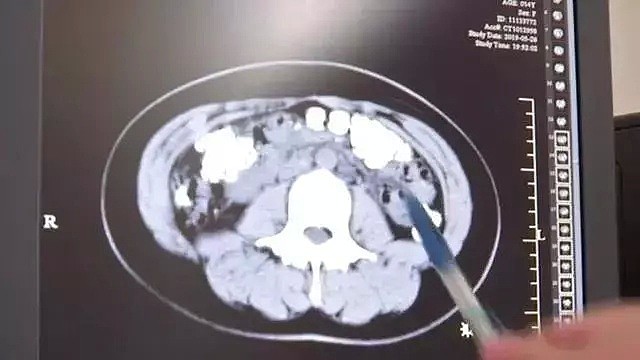 澳媒惊曝：华人女孩进急诊，昏迷透析5天才醒来！罪魁祸首竟是无数华人的最爱（组图） - 37