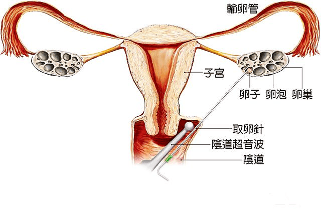 陈凯歌“代孕”短片被围观5亿次的背后，是无数个无奈拿子宫换钱的女人（组图） - 15