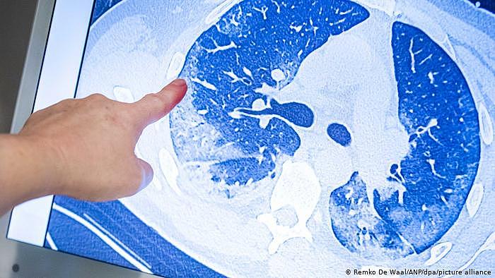 Coronavirus I CT-Aufnahme Lunge