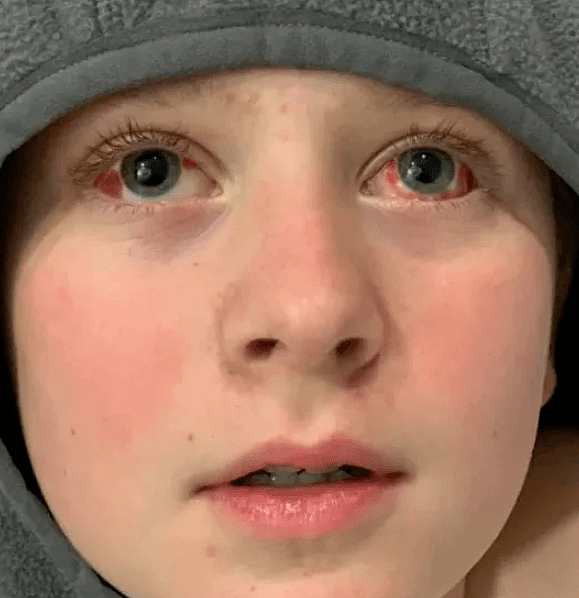11岁男孩患新冠出现新症状：眼睛和手变成红色，双脚却变成蓝色（组图） - 2