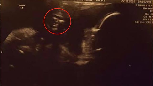 孕妇拍B超竟见诡异一幕：照片中惊现特朗普的脸，正在凝视着自己（组图） - 1