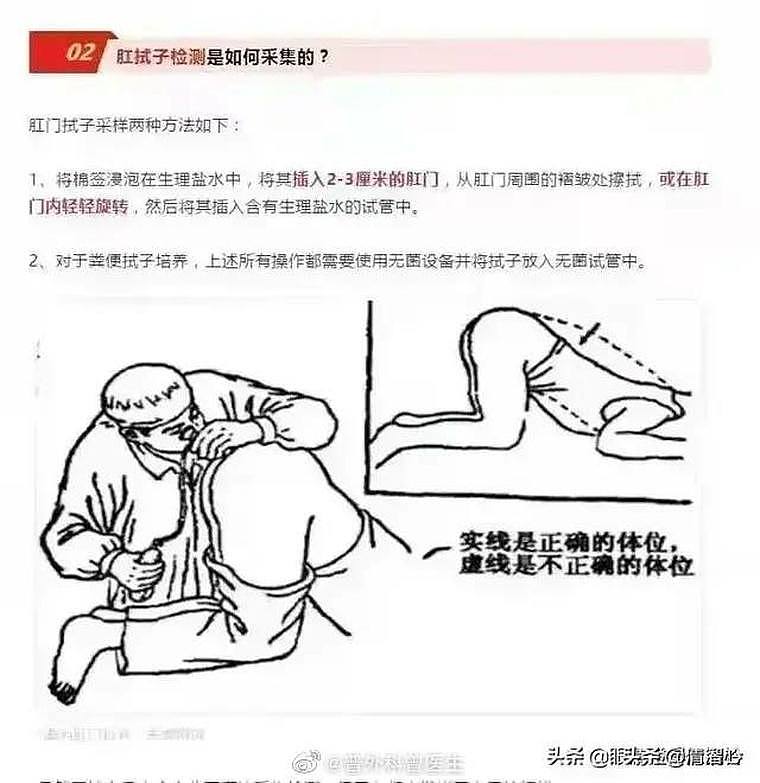 图为中国的肛筛解说图。 翻摄微博