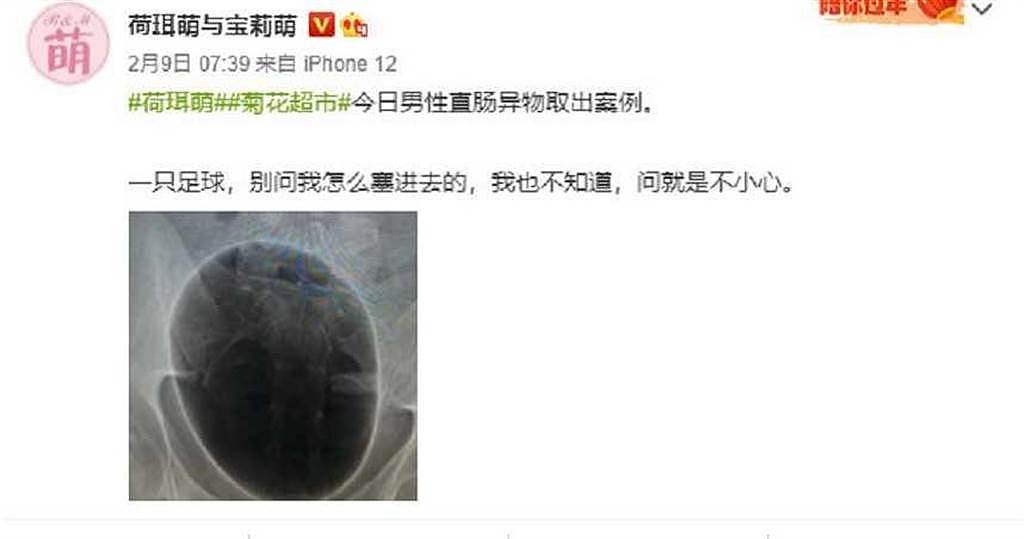 中国微博博主「荷珥萌与宝莉萌」9日PO了一条贴文分享，一名男性直肠塞入1颗21公分大足球。 （图／翻摄自微博／荷珥萌与宝莉萌）