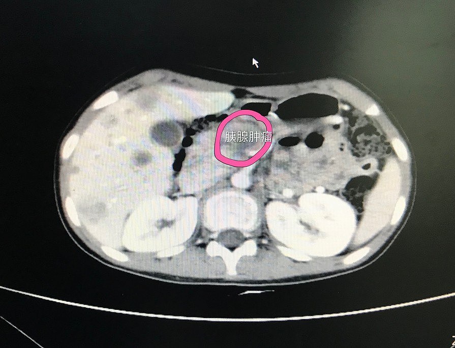 浙江12岁男孩反复腹痛，查出已是晚期，失去手术机会……