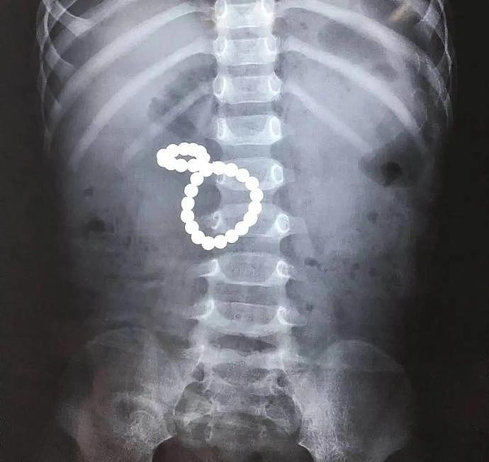 “夺命”磁力珠！中国2岁男童误食28颗致4处肠穿孔，险丧命（组图） - 2