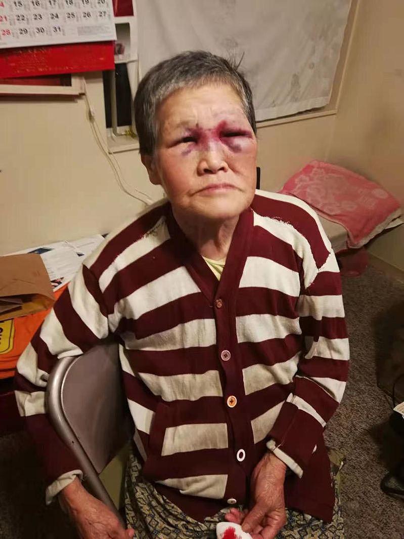75岁的旧金山华裔婆婆谢萧珍（Xiaozhen Xie）还击歹徒袭击，目前正在养伤。 （陈德和供图）
