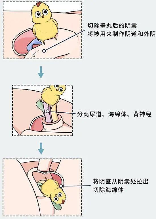 网红Abbily承认未做手术仍是男生：变性手术的可怕，不仅仅是蛋痛（视频/组图） - 7