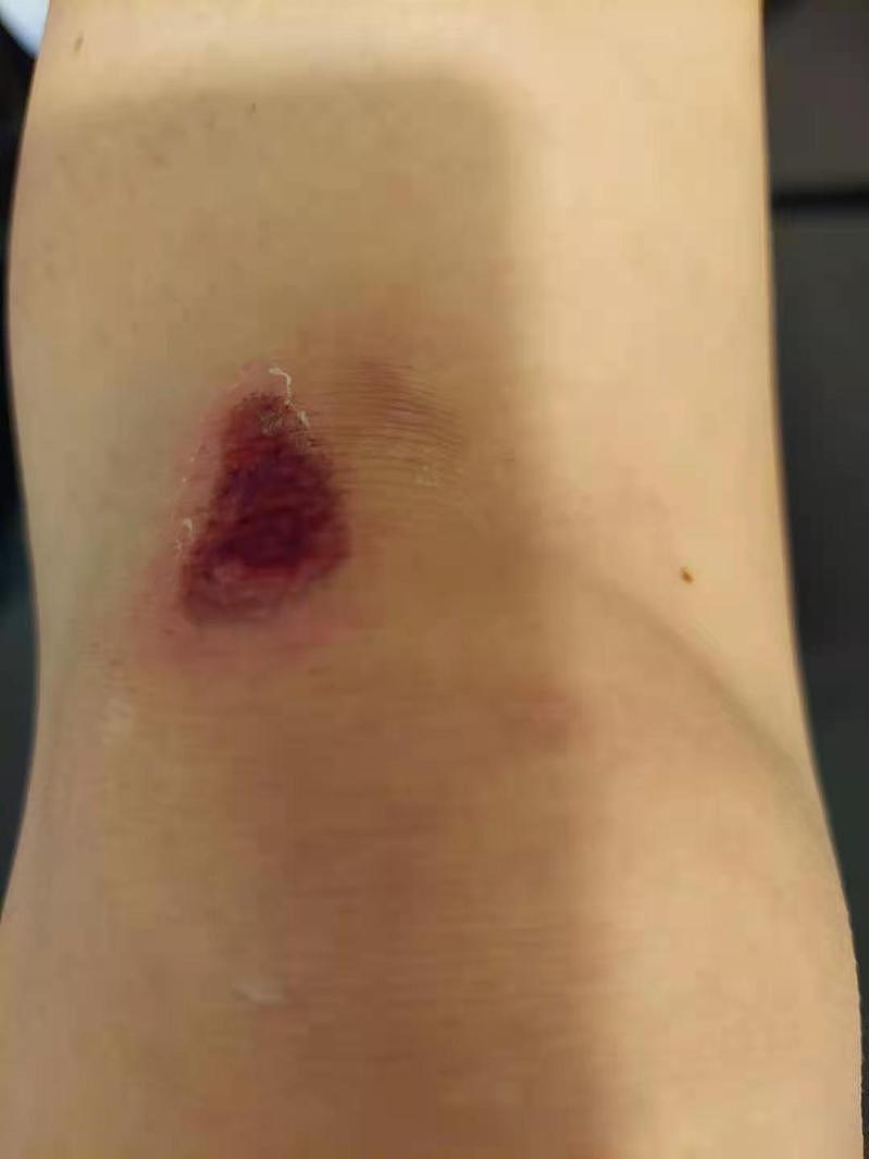 江克萝在地铁站遇袭后，左腿擦伤，血迹沾湿衣裤。 (江克萝提供)