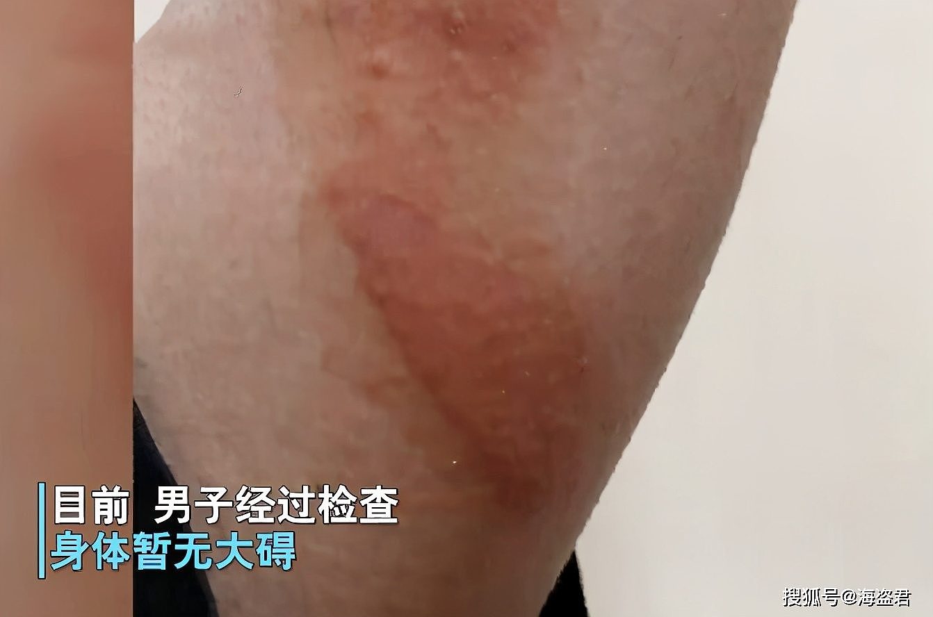 中国男子三星手机爆炸，女友崩溃：现在趴他脸上都看不见睫毛了（视频/组图） - 5