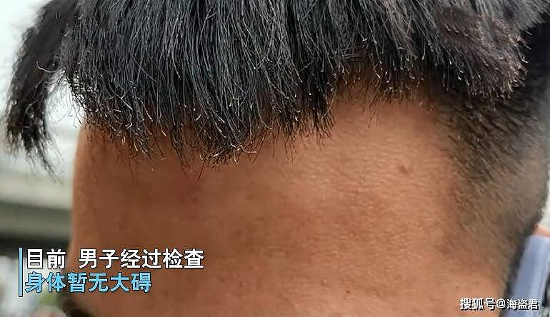 中国男子三星手机爆炸，女友崩溃：现在趴他脸上都看不见睫毛了（视频/组图） - 6