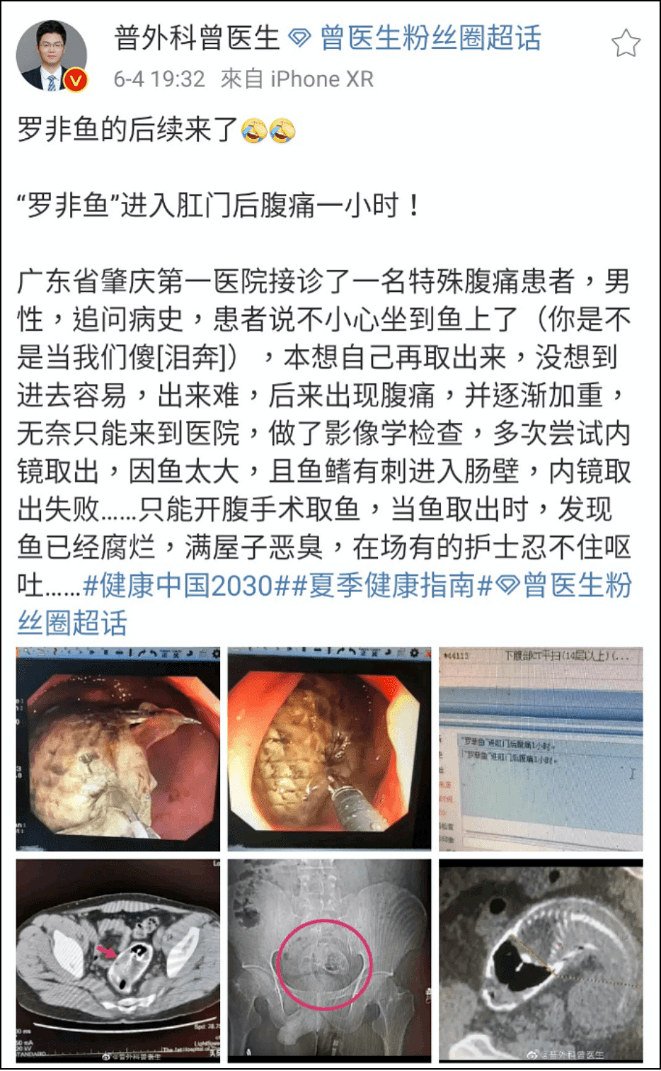 “小龙虾越爬越凶，已钻到我的肚子了”！14岁中国男孩把活龙虾塞进肛门吓到求医，原因竟是…（视频/组图） - 5