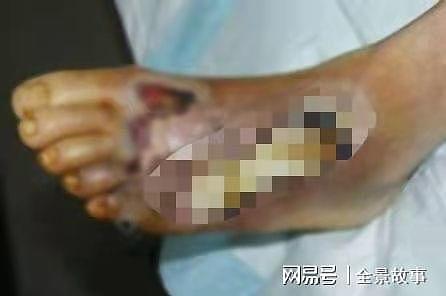 慢性病患者现状：无视糖尿病十二年，我终于把自己熬成了一个瞎子（组图） - 2