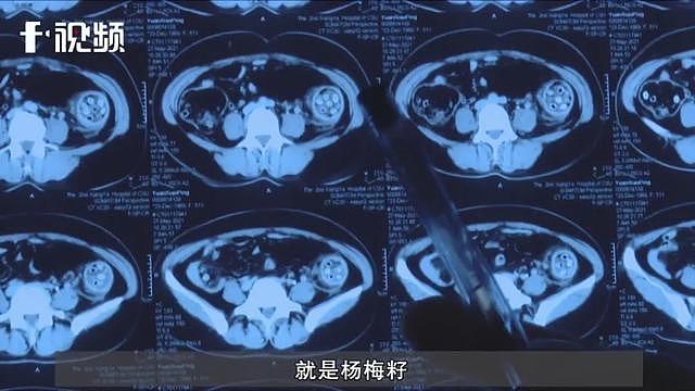 中国一女子体内惊现百余颗杨梅核！医生手术时发现，肠管几乎都是...（视频/组图） - 1