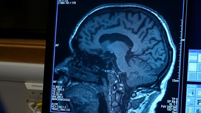 英国阿尔茨海默症患者阿尔多·塞雷萨（Aldo Ceresa）的脑部扫描影像
