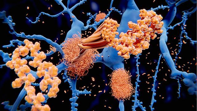 设计图片：淀粉样蛋白斑块在脑内积聚