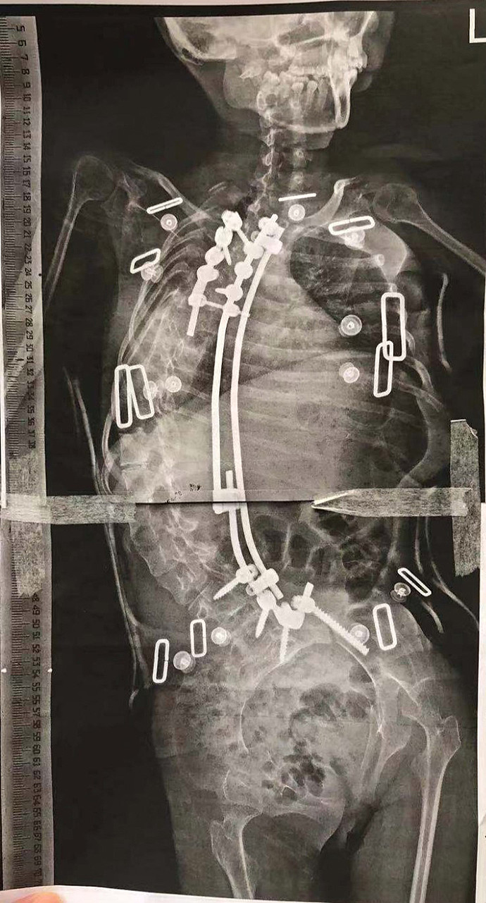 13岁女孩脊柱侧弯176度说话不成句，在上海接受矫治手术