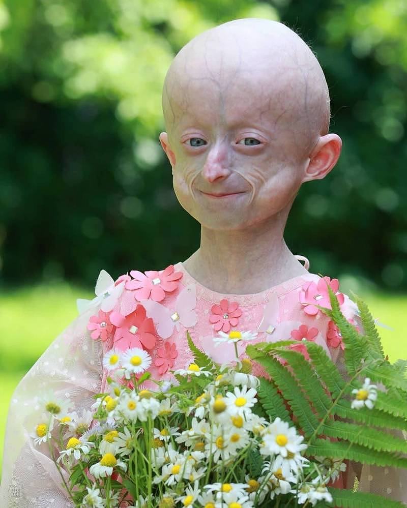 乌克兰女童希米奇患有「早年衰老症候群」不幸于上月30日逝世，得年10岁。 （图撷取自Діна Химич脸书）