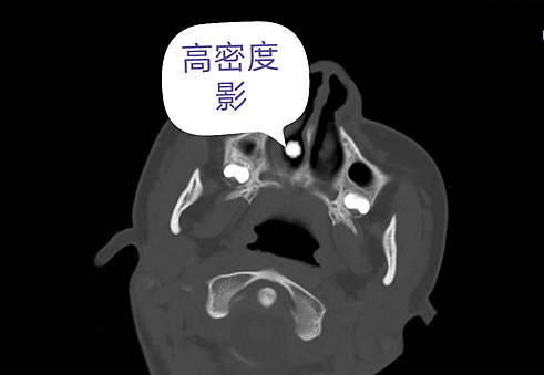 杭州女孩上课时鼻血喷涌，医生从鼻腔取出钢珠，竟已潜伏十多年