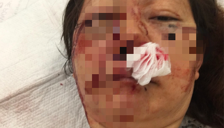 家人公布的邓女士伤势照片。 （取自Gofundme）