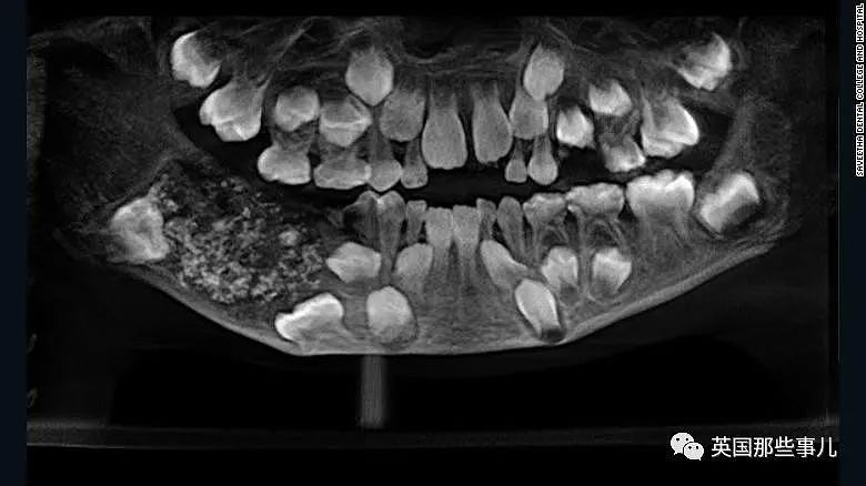 印度少年长82颗牙齿震惊医生，没想到还有人长过526颗?