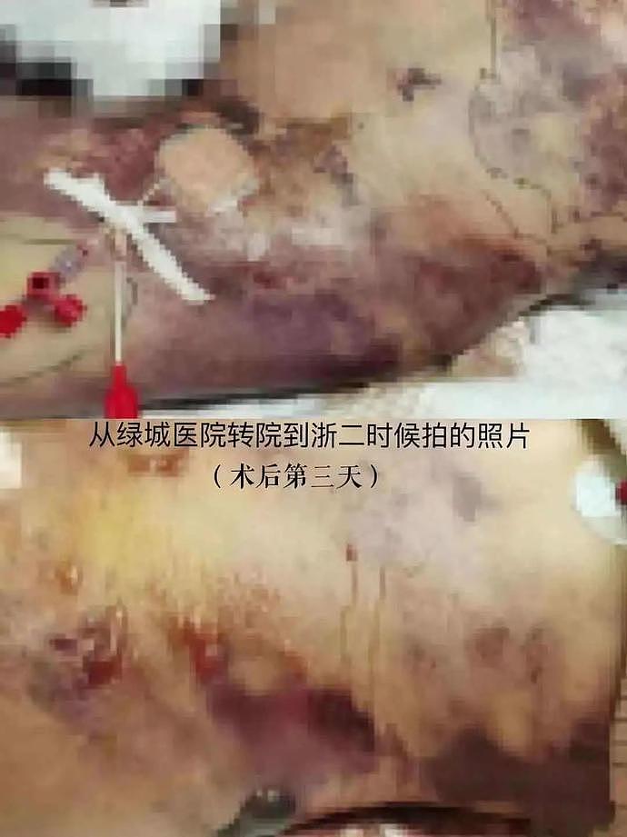 超美网红抽脂后活活疼死，生前照片惨不忍睹！割阴唇、开头颅…为变美太疯狂（组图） - 6