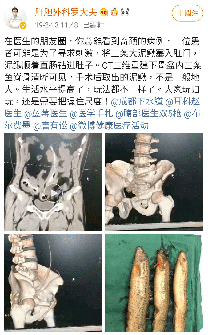 阴道里塞手枪算啥，我还见过更奇葩的：拿黄瓜清洁、异物的种类多种多样！（组图） - 4