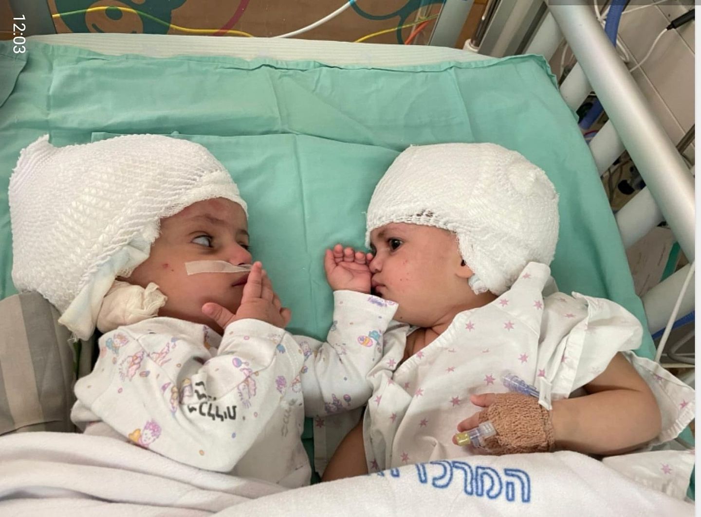 以色列连体婴头部相连一年，经12小时手术成功分离终见彼此（组图） - 1
