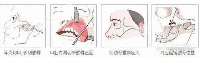 做了颧骨内推的明星真的变美了吗？推平容易后悔难，后遗症竟然一大堆！（组图） - 24