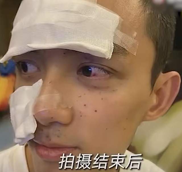 42岁李晨拍戏被炸伤！火药碎片扎入眼球，受伤后要求重拍吓坏吴京（组图） - 16