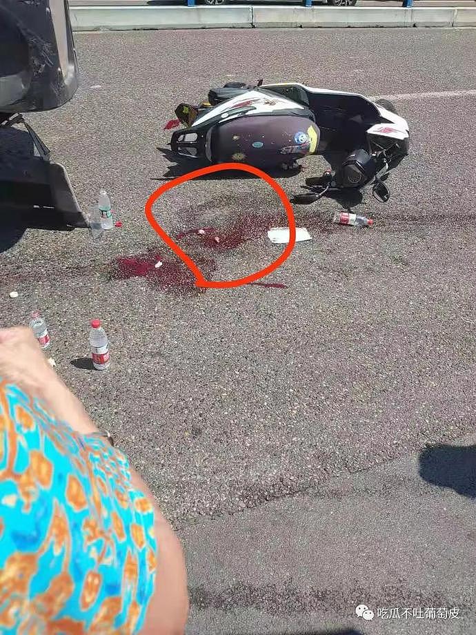 摩托车祸撞飞“蛋蛋”，两颗睾丸散落滚烫柏油马路上，还能再移植回去吗？（视频/组图） - 1