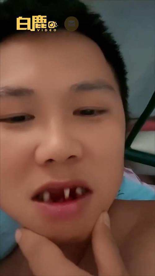 男子看完《长津湖》学吃冻土豆拔掉3颗牙，网友：牙齿不好不要轻易学（组图） - 3