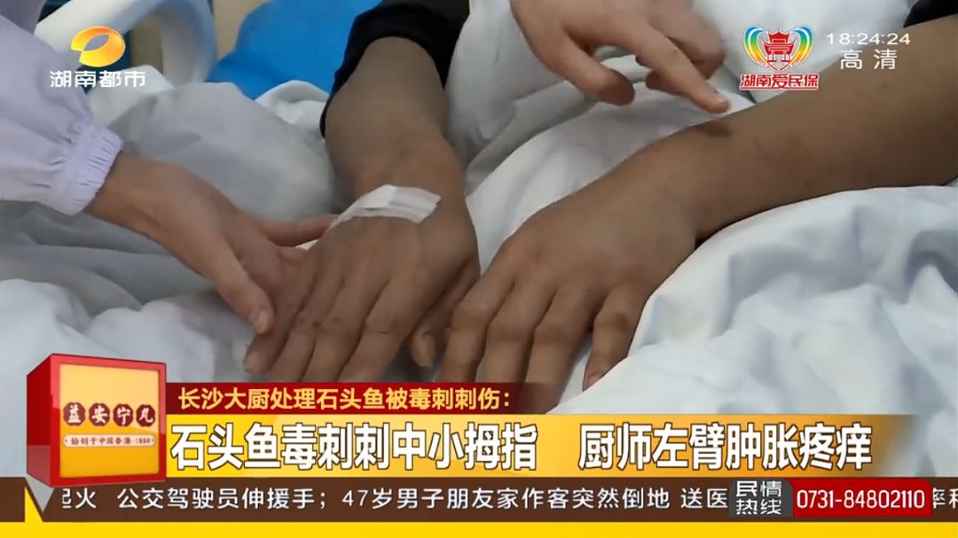 鱼刺扎一下，厨师被紧急送医！医生：这种鱼刺6根可致死