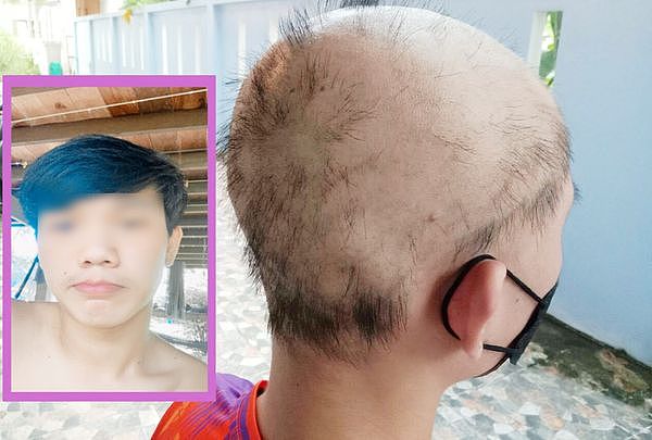 ▲▼泰国19岁少年打完2剂科兴「头发掉光」全秃。（图／翻摄自Dailynews）