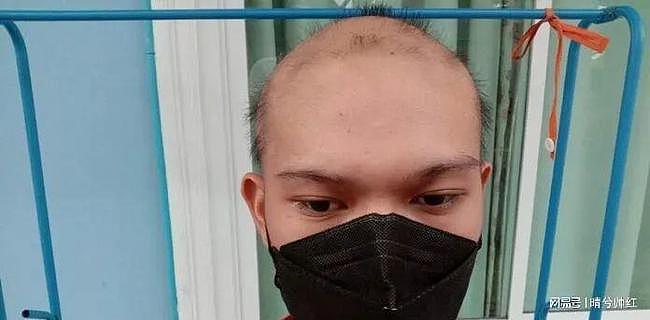 19岁少年打完2剂科兴疫苗后不停掉头发，秃的几乎成光头，他称接受不了自己现在的样子（组图） - 3