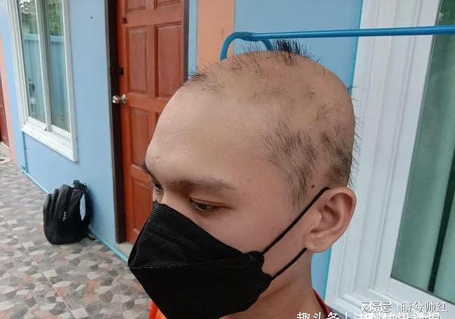 19岁少年打完2剂科兴疫苗后不停掉头发，秃的几乎成光头，他称接受不了自己现在的样子（组图） - 2