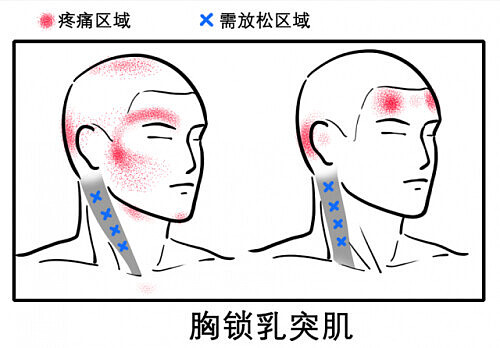 八成头痛和颈椎有关！一份“疼痛位置图解”帮你对症放松