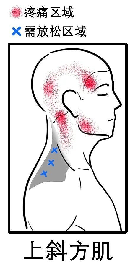 八成头痛和颈椎有关！一份“疼痛位置图解”帮你对症放松