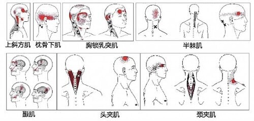 八成头痛和颈椎有关！一份“疼痛位置图解”帮你对症放松