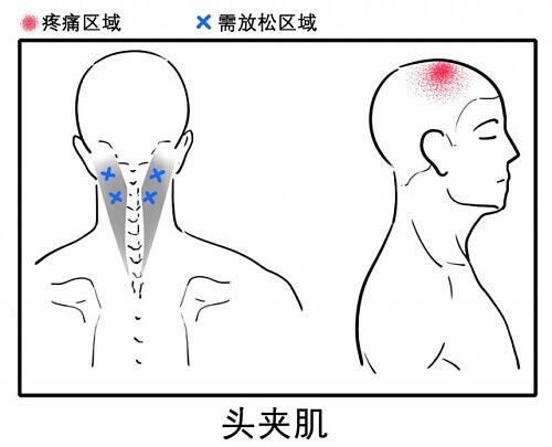 八成头痛和颈椎有关！一份“疼痛位置图解”帮你对症放松