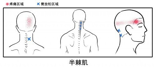 八成头痛和颈椎有关！一份“疼痛位置图解”帮你对症放松