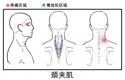 八成头痛和颈椎有关！一份“疼痛位置图解”帮你对症放松