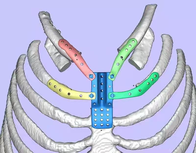 胸骨被肿瘤“啃食”，青海男子装上3D打印“铁骨”