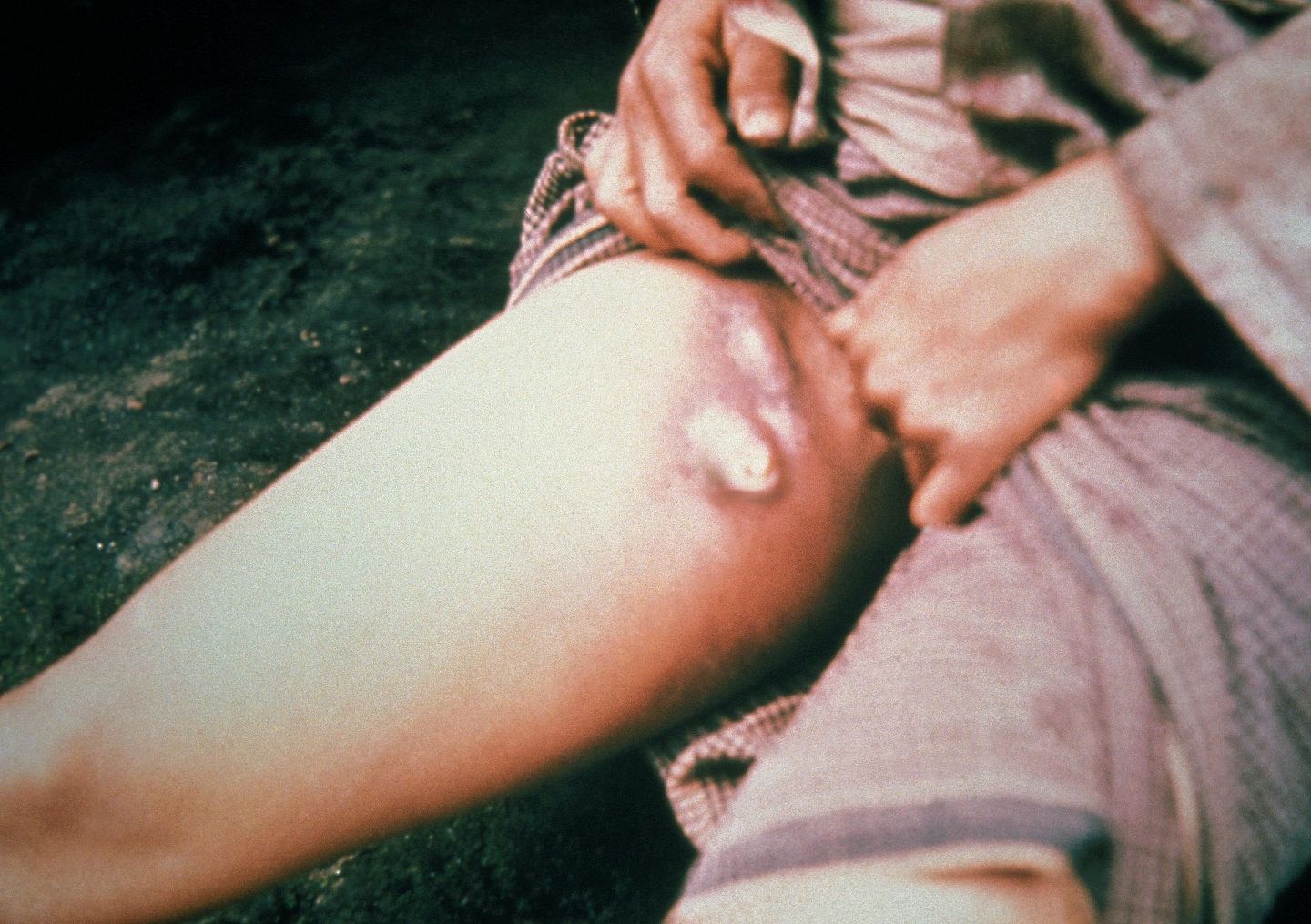 淋巴腺鼠疫患者出现在大腿上方的典型征状。（Wikimedia Commons）