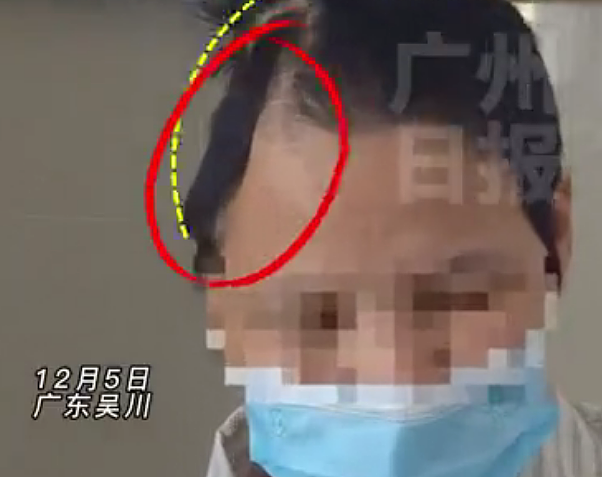 广东一女子突发车祸，头颅被“削”掉一半！十天后…奇迹存活