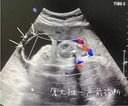 崩溃！厦门一女子怀孕5个月，发现胎儿竟有“尾巴”