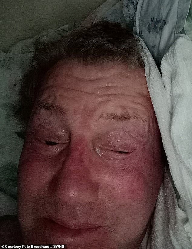 英国79岁大爷整形失败，左眼3年闭不上，生活太痛苦