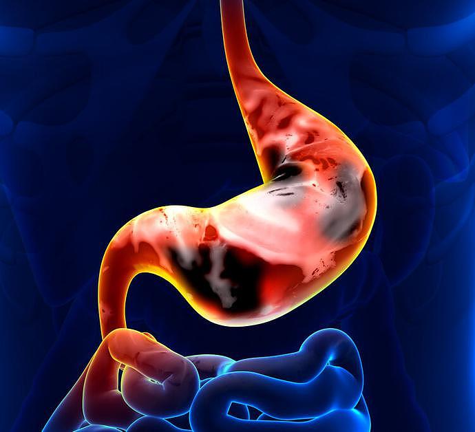 胃癌早期不痛不痒，一旦发现这6个症状，或是胃癌“找上门”（组图） - 4
